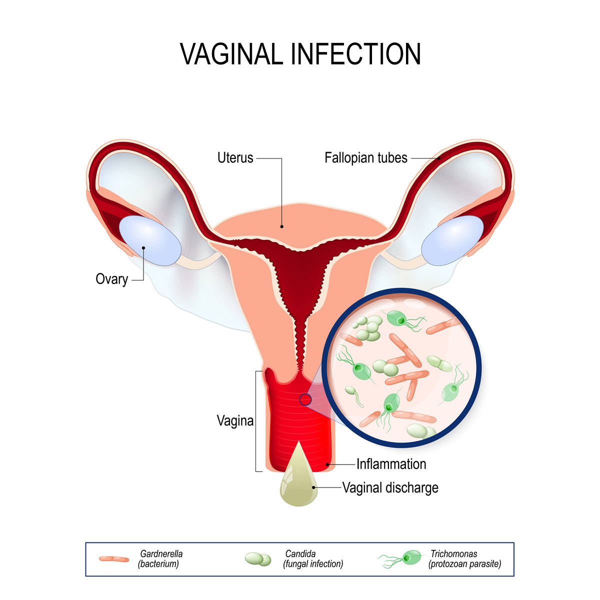 Vaginální infekce patogenem